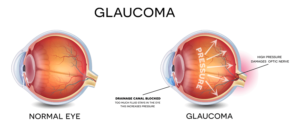 glaucoma